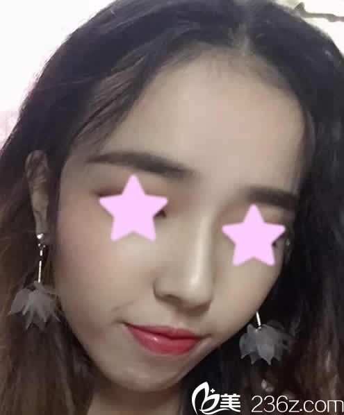 我找长治悦美整形薛艳峰做鼻综合术后第10天照片 我找长治悦美整形薛艳峰做鼻综合术后第10天照片