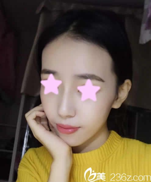 说说我找长治悦美整形薛艳峰院长做鼻综合价格及术后18天恢复效果