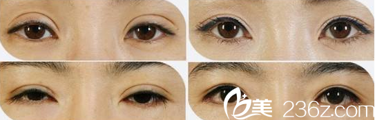 失败双眼皮修复案例对比图