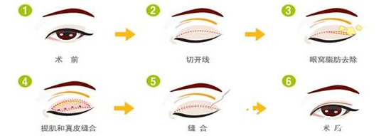 双眼皮修复手术方法