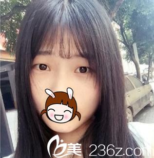 术前单眼皮 术前单眼皮