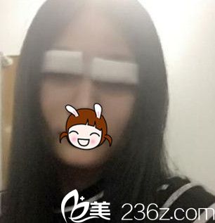 刚做完7mm平行双眼皮 刚做完7mm平行双眼皮