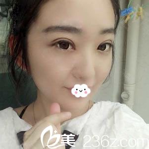 阜阳眼修复哪家好？东方美莱坞勇中华双眼皮失败修复真人案例