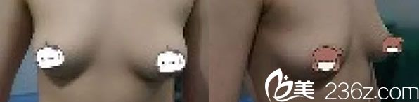 韩国艺雅特整形隆胸手术前 韩国艺雅特整形隆胸手术前