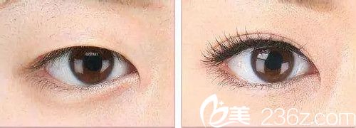 双眼皮手术不对称怎么修复