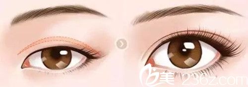 双眼皮手术修复