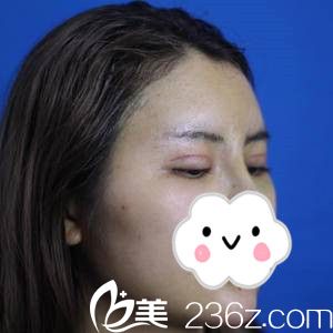 双眼皮拆线后的效果