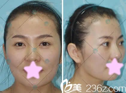 我在大同清木整形做线雕提升前的照片 我在大同清木整形做线雕提升前的照片