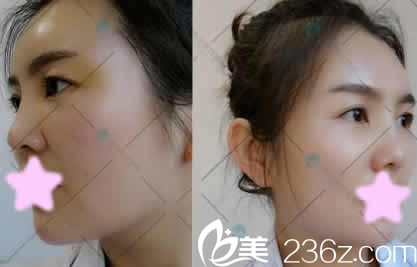 我在大同清木整形做全脸线雕提升后第3天照片 我在大同清木整形做全脸线雕提升后第3天照片