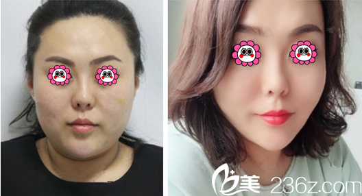 吸脂术瘦双下巴案例