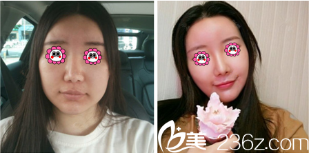 瘦双下巴案例