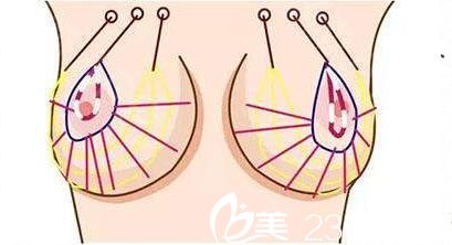 自体脂肪隆胸效果好不好？