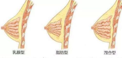 自体脂肪隆胸需要做几次？