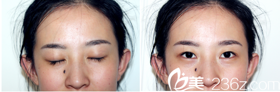 看我术前照片是不是很喜庆 看我术前照片是不是很喜庆