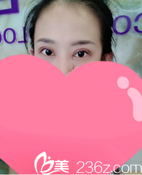 刚做完的时候真的是肿成狗了 刚做完的时候真的是肿成狗了