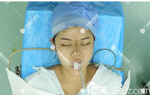 广州曙光隆鼻手术过程图