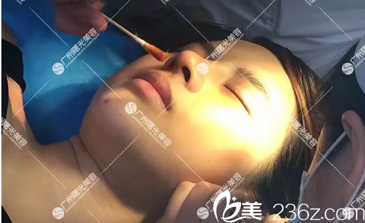 广州曙光郭建隆鼻案例术后7天拆线 广州曙光郭建隆鼻案例术后7天拆线