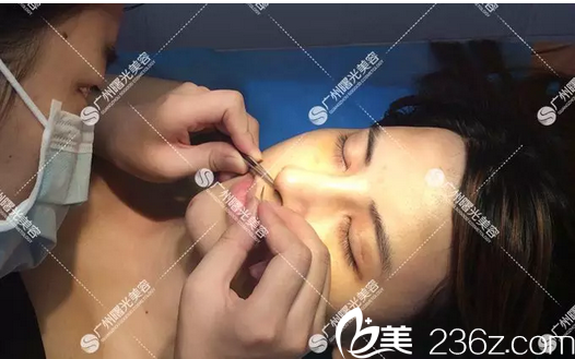 广州曙光隆鼻术后14天拆内线 广州曙光隆鼻术后14天拆内线