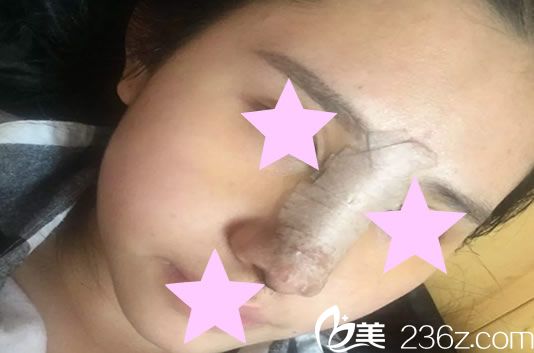 硅胶假体隆鼻手术第1天 硅胶假体隆鼻手术第1天