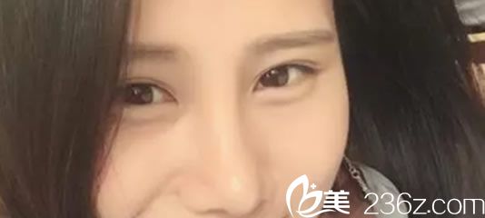 鼻综合术后10天照片 鼻综合术后10天照片