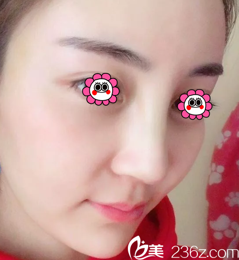 北京美莱鼻修复案例 北京美莱鼻修复案例