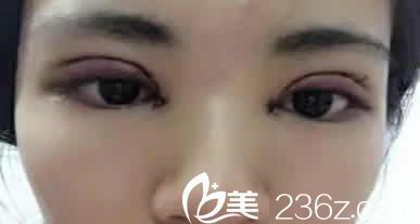 太原天使名源唐义灵医生给我做韩式双眼皮加开眼角后第3天照片