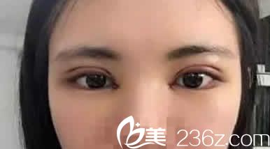 太原天使名源医疗整形唐义灵给我做韩式部分切开双眼皮后第5天照片