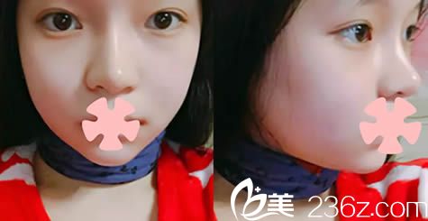 韩国新帝瑞娜整形面部轮廓术后14天照