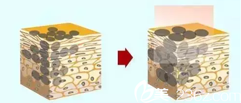 激光祛斑原理 激光祛斑原理