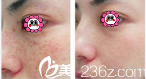 激光祛斑的危害与效果多长时间 20181017_1539747023184825.png