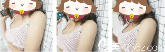 上海德琳医疗美容医院宋鸿植假体隆胸真人案例术后第十天