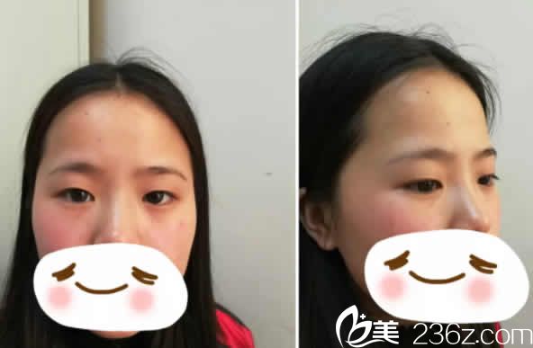 我在太原时光整形医院做眼部整形前的照片 我在太原时光整形医院做眼部整形前的照片