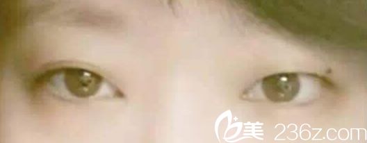 韩国YNT整形外科医院全切双眼皮手术前 韩国YNT整形外科医院全切双眼皮手术前