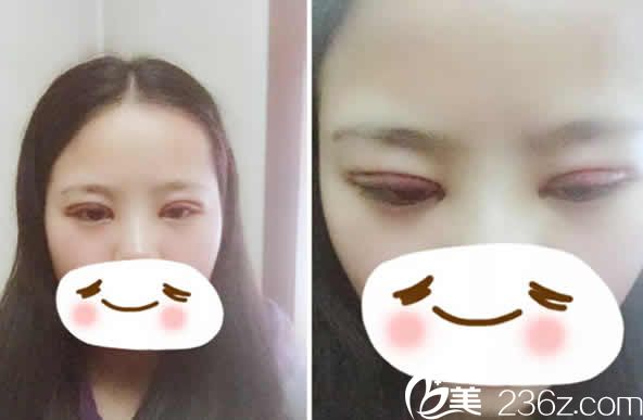 太原时光整形李晨霞医生给我做全切双眼皮加开眼角术后第3天照片 太原时光整形李晨霞医生给我做全切双眼皮加开眼角术后第3天照片