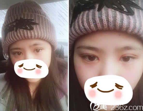 我在太原时光整形做切开双眼皮和开眼角术后第12天照片 我在太原时光整形做切开双眼皮和开眼角术后第12天照片