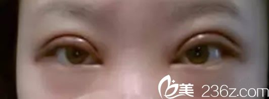 全切双眼皮手术第1天 全切双眼皮手术第1天