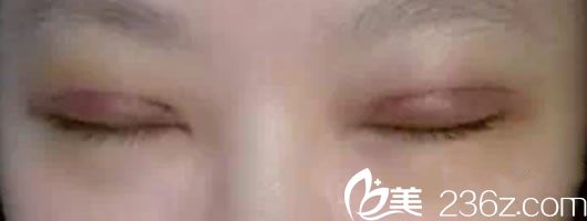 割双眼皮7天后的恢复效果 割双眼皮7天后的恢复效果