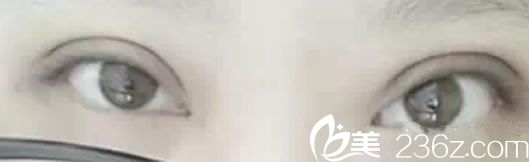 全切双眼皮20天恢复图 全切双眼皮20天恢复图