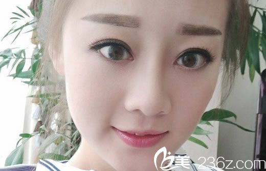 好不容易预约到杭州瑞晶李晓东院长手术时间,索性把双眼皮和隆鼻手术一起做了