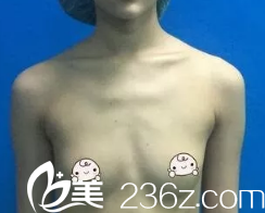 术前胸部平坦 术前胸部平坦