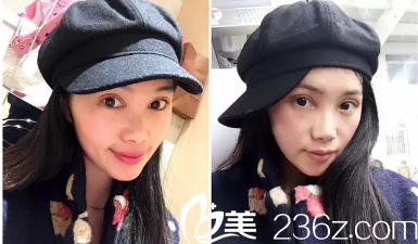 做完眼睛之后真的很肿