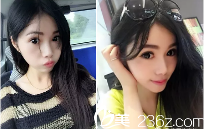 惊呆了！10月2号在整形医院做的全切双眼皮，花了我一万多