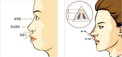 隆鼻失败的原因