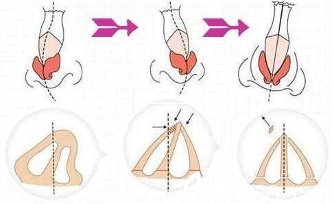 什么是隆鼻修复