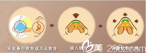 隆鼻修复手术方法