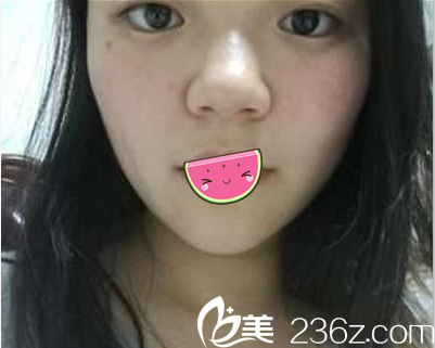 成都禾臣瑞亚医疗美容门诊部赵兴阳术前照片1