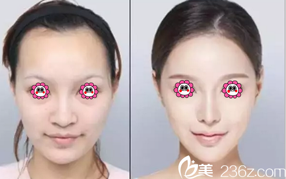 蓝绍梓注射微整真人案例 蓝绍梓注射微整真人案例