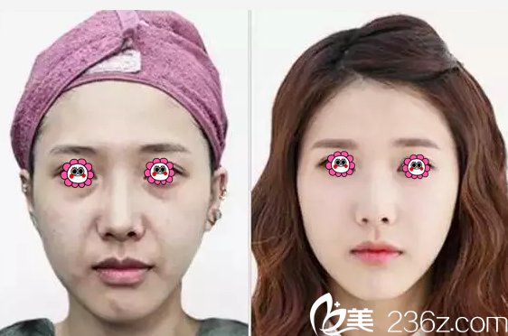 蓝绍梓注射抗衰老真人案例 蓝绍梓注射抗衰老真人案例