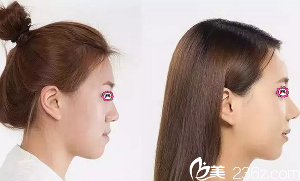 蓝绍梓天使之翼艺术鼻雕真人案例 蓝绍梓天使之翼艺术鼻雕真人案例