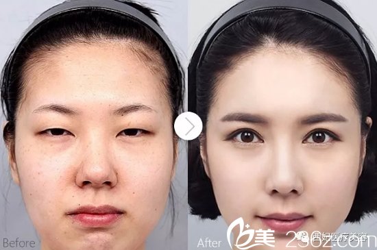 东莞华美任家骠做的双眼破隆鼻<span style=